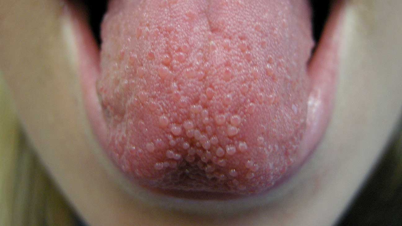 لکه های سفید روی زبان