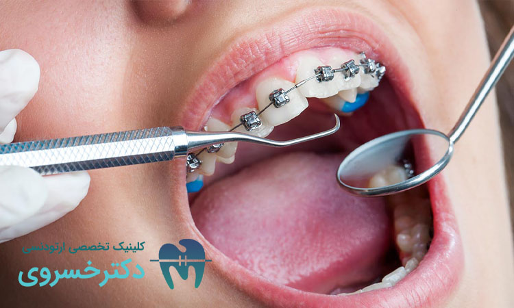 تصمیم ارتودنسی در بزرگسالی عقلانی و درمانی است؟
