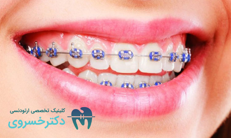 ارتودنسی بزرگسالان چیست؟