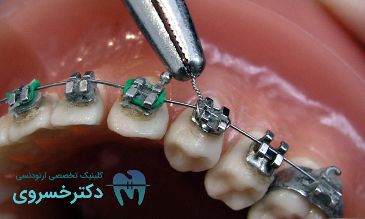 بررسی عقلانی بودن تصمیم ارتودنسی در بزرگسالی