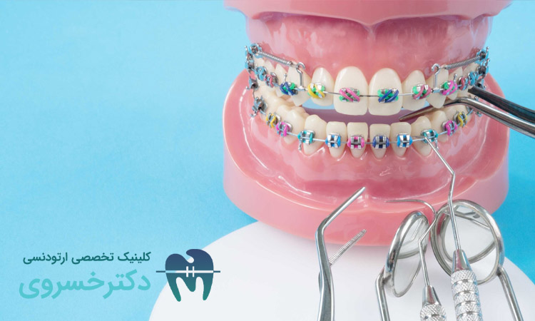 بهترین روش ارتودنسی بزرگسالان