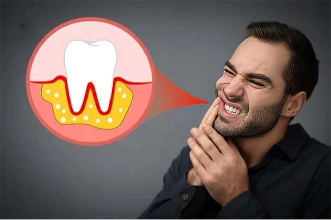 لزوم کشیدن دندان عقل حتی در صورت ظاهر سالم