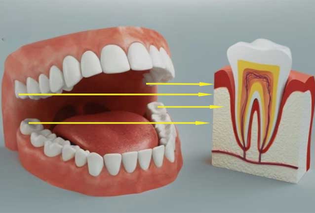 لزوم کشیدن دندان عقل حتی در صورت ظاهر سالم