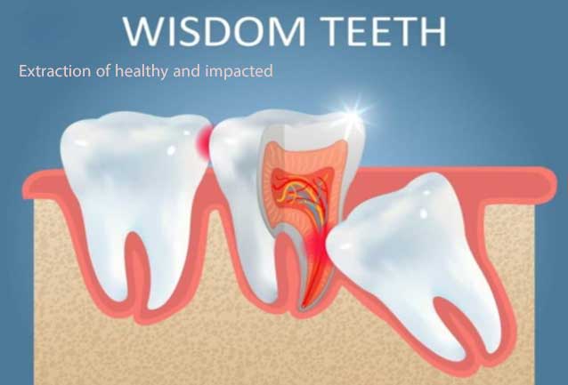 لزوم کشیدن دندان عقل حتی در صورت ظاهر سالم